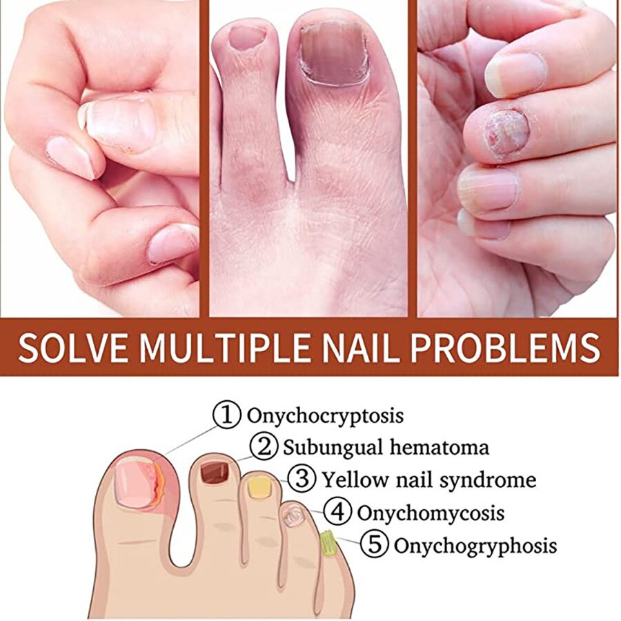 7 DAYS Repair Nail Fungus Treatments Essence Foot Care Serum Toe Nails Fungal Removal Gel Anti-Infection Onychomycosis